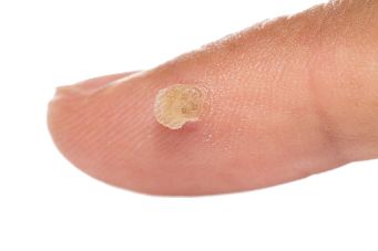 استعمال Skincell پرو مقدمے میں, اگر آپ کو جلد دھبوں ، moles ، warts کے, عمر سے متعلق جلد تبدیلی