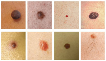 سب سے زیادہ عام جلد کے دھبوں ہے nevus اور papilloma (warts)