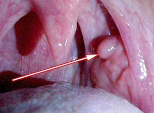 larynx میں پاپیلوما