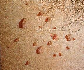 جلد پر انسانی پیپیلوما وائرس
