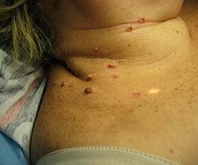 گردن پر انسانی پیپیلوما وائرس