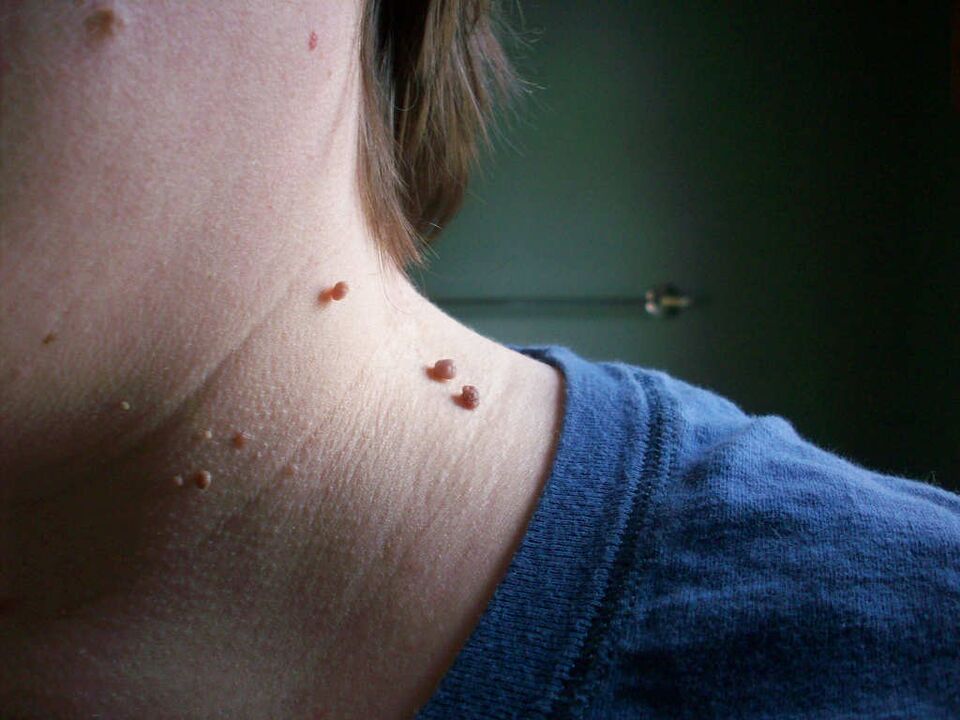 گردن پر پیپیلوما کا علاج کیسے کیا جائے۔